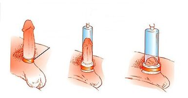The principle of operation of the pump for the increase in penis