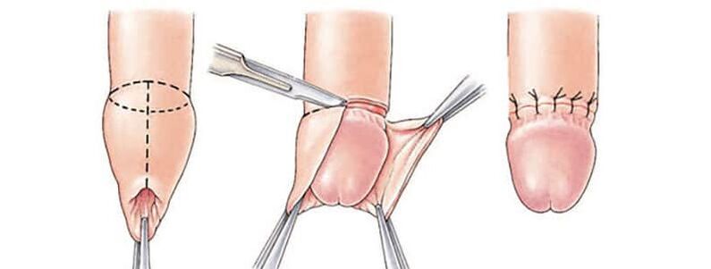 Impact of circumcision on the size of the penis